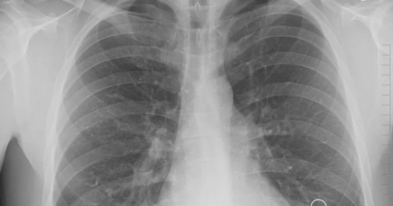 В Магаданской области за 2020 год заболели туберкулёзом 40 человек