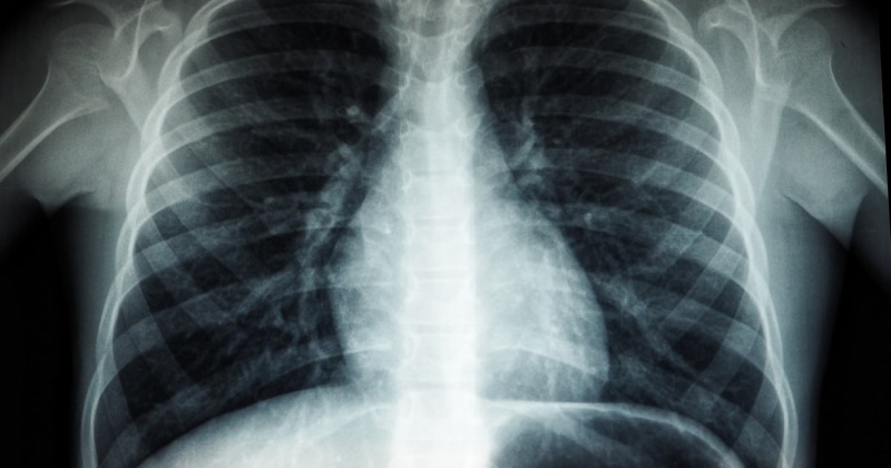 За 2021 год в Магадане и регионе заболели туберкулёзом 43 человека